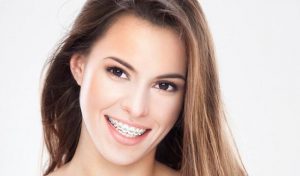 A woman wearing dental braces smiles at the camera. 