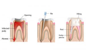A hand drawn graphic showing the 3 step process of a root canal treatment. 