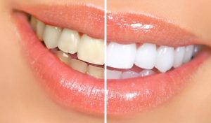 A before and after image of a showing the results of teeth whitening on a female. 