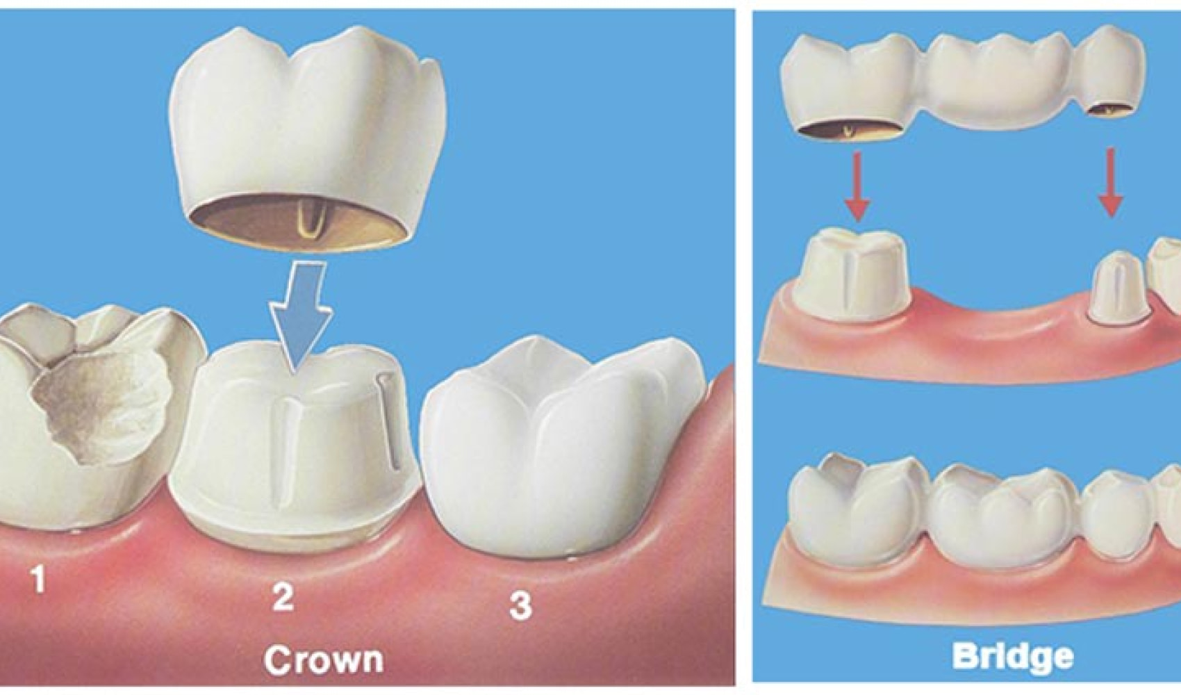 Dent Zirconia Crown before after