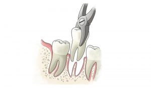 An illustration of a tooth being extracted.