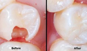 Before and after images showing tooth decay.
